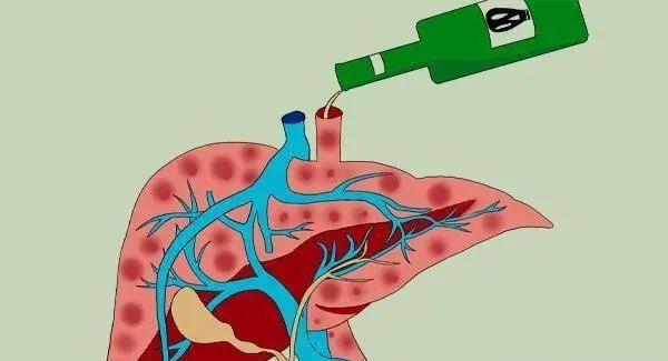 男子一周喝4斤酒致肝衰竭