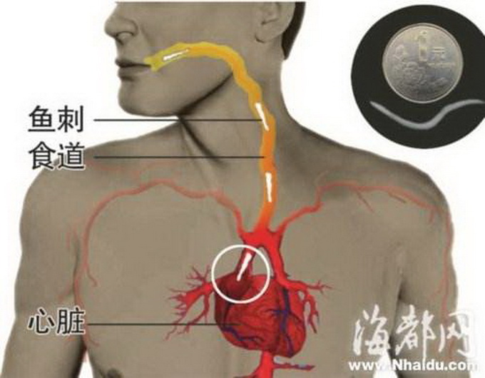 主持人不慎吞下鱼刺：穿出胃扎到肝