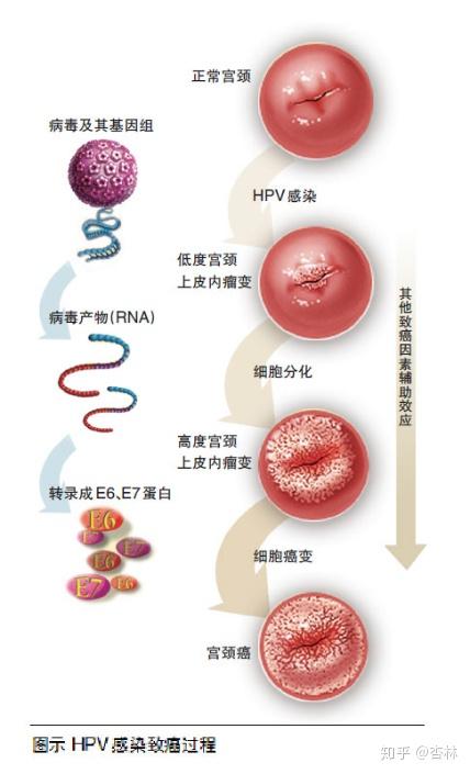 从HPV感染到宫颈癌，只有5步